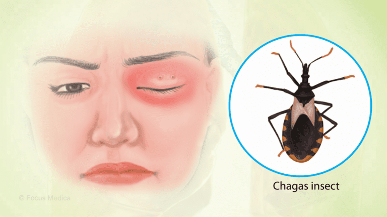Experts Say We Should Track Chagas Disease in Food Sickness Counts